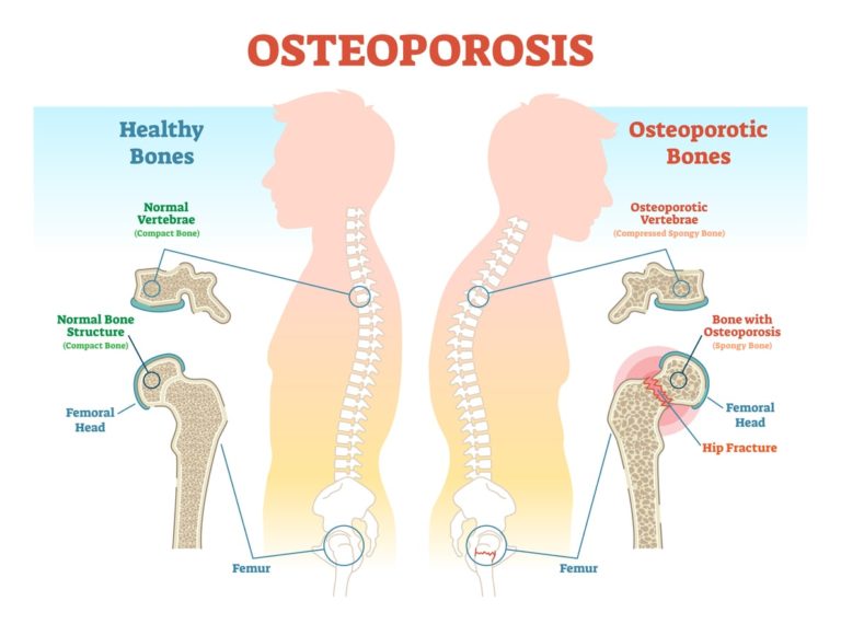 Bone Disease Osteoporosis Nyc Manhattan